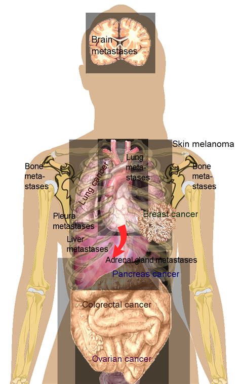 ملف:Metastasis sites for common cancers.svg - المعرفة