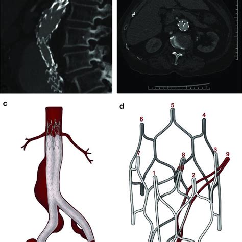 Type Ii Endoleak With Inferior Mesenteric Artery Lower Arrow Filling