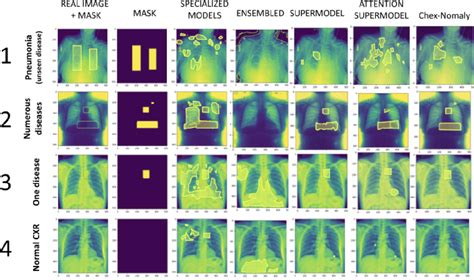 Chex Nomaly Segmenting Lung Abnormalities From Chest Radiographs Using