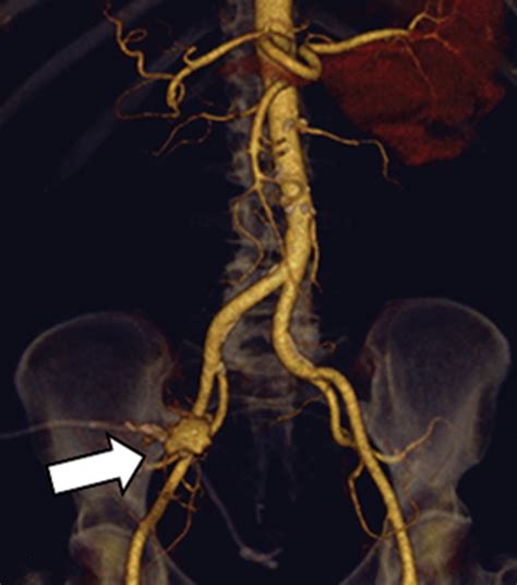 The Renal Vasculature What The Radiologist Needs To Know Radiographics