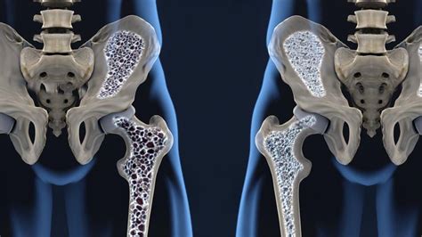 Osteoporosis qué es síntomas y tratamiento MD Saúde