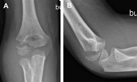 Representative X Ray Of A Fracture Of The Lateral Condyle Which Could Download Scientific