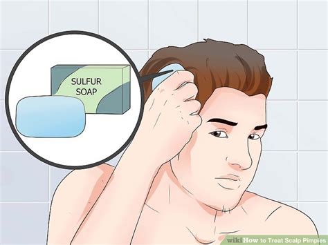 How To Treat Scalp Pimples 15 Steps With Pictures Wikihow