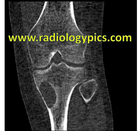 Unknown Case 16 Pediatric Tibial Lytic Lesion Radiologypics Com