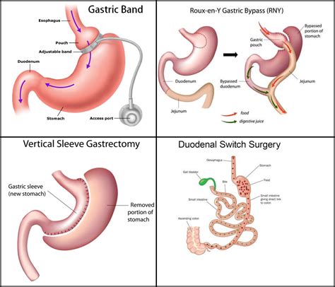 Pembedahan Bariatric Untuk Kuruskan Badan 8 Perkara Yang Ramai Nak Tahu