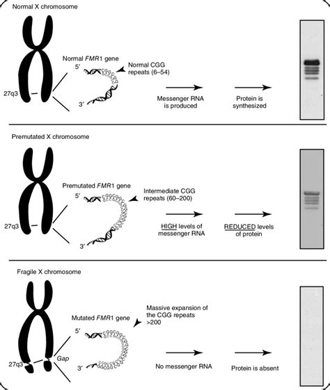 Fragile X Syndrome Karyotype