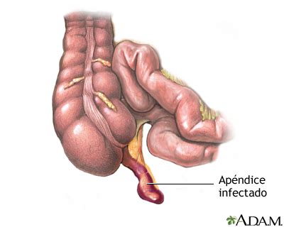 Clínica Digestiva de la Riviera Maya Apendicitis Aguda