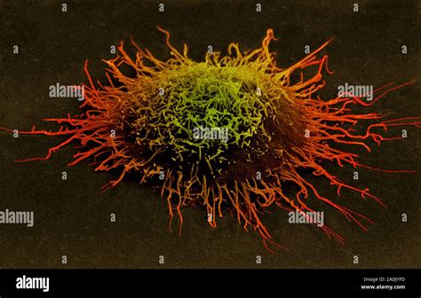 Cervical Cancer Cell Coloured Scanning Electron Micrograph Sem Of A