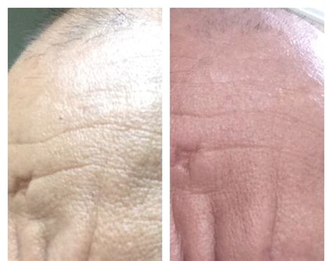 Before And After Nerium International Nerium Ad Nerium