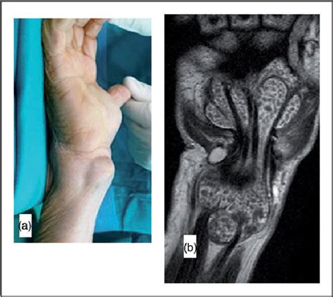 Figure 1 From Isolated Extrapulmonary Tuberculosis With Flexor Tenosynovitis And Compression Of