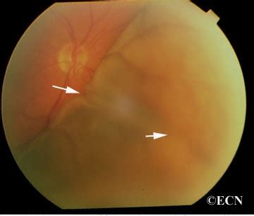 Choroidal Effusion New York Eye Cancer Center