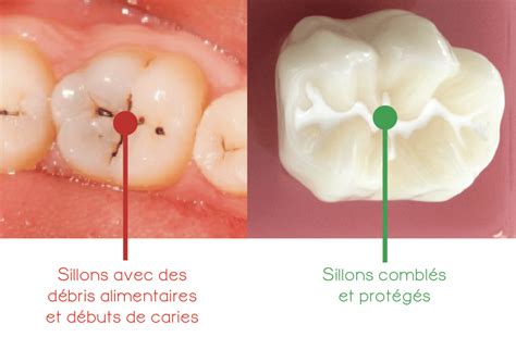 Prévention Bucco Dentaire Pour Enfants Dentiste