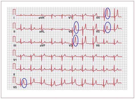 Hyperkalémie EKG Medicína nemoci studium na 1 LF UK