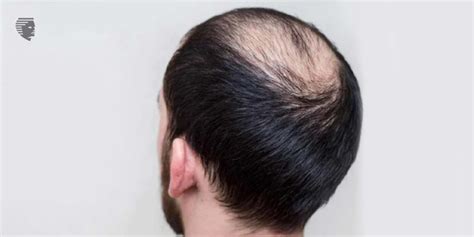 Medication That Can Cause Hair Loss And How To Prevent It Ahs Uae