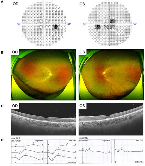 Frontiers Autosomal Recessive Rod Cone Dystrophy Associated With