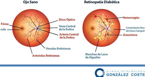 Cuáles son los síntomas de la retinopatía diabética causas y tratamiento