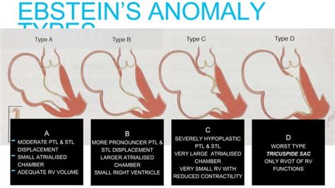 Tricuspid Valve Disease Ppt