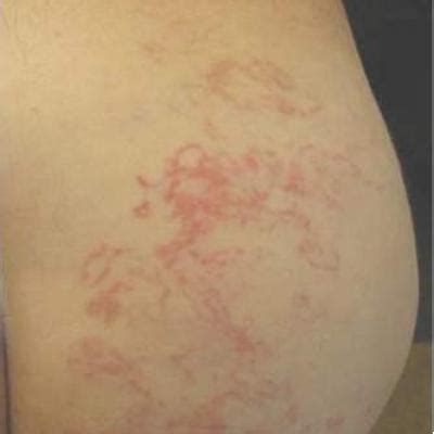 Acute Serpiginous Rash | MDedge Dermatology