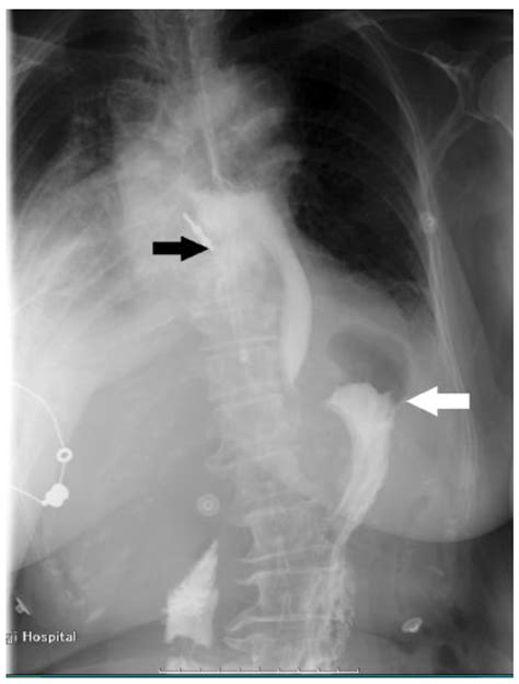 Spontaneous Rupture Of Esophageal Diverticulum—a Case Report And