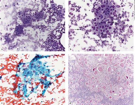 Figure 1 From Fine Needle Aspiration Cytology Of Thyroid Nodules With