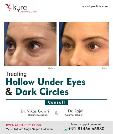 Under Eye Treatment Cosmetic Surgery In Ludhiana Plastic Surgery In