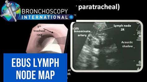 Bronchoscopic Anatomy - Anatomy Reading Source