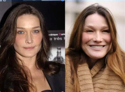 Carla Bruni Les Chirurgies Esth Tiques Qu Elle A Subi