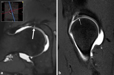 Mri Hip Arthrogram With Radial Mpr Slice Thickness Mm Of An