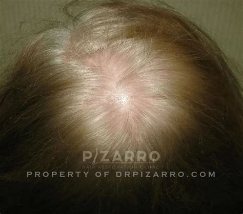 Gallery Pizarro Hair Restoration