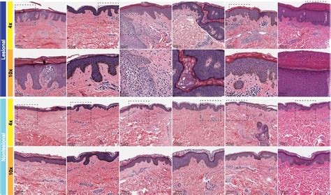 Hande Of Ad Lesional And Non Lesional Skin Magnification At × 4 And × 10