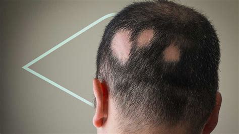 Alopecia Areata Tratamiento Causas y síntomas