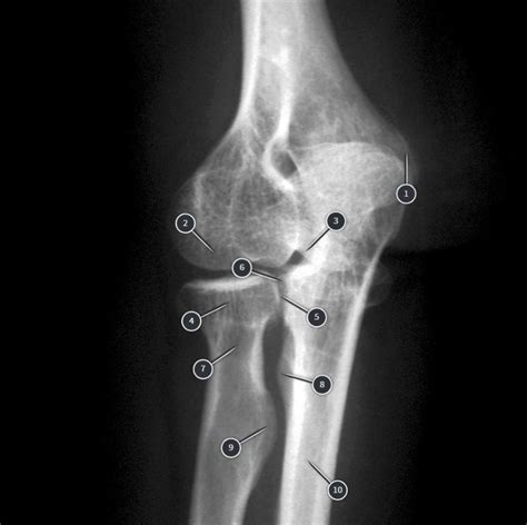 Unit 2 Radiology Of The External Oblique Elbow Diagram Quizlet