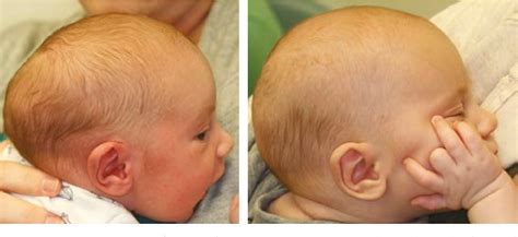 Figure 3 from Bathrocephaly: a case report of a head shape associated ...