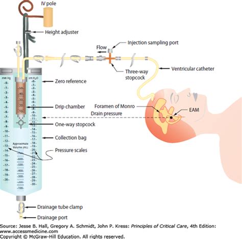 Intracranial Pressure Monitoring And Management Anesthesia Key