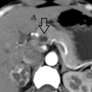 -Open arrow showing pancreatic cyst in body of pancreas. | Download Scientific Diagram