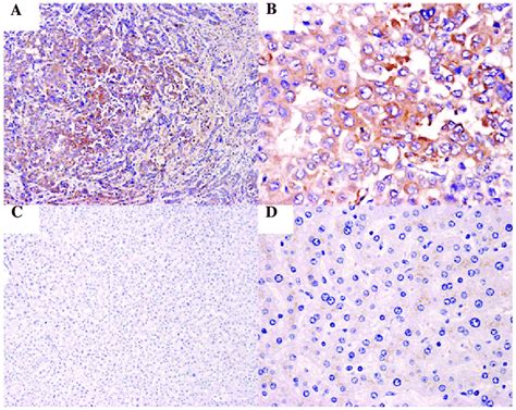 Immunohistochemical Analysis Of Stc2 In Hepatocellular Carcinoma A