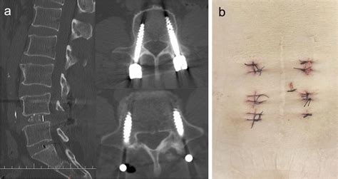 Postoperative Ct Shows That The Position Of The Cage And New