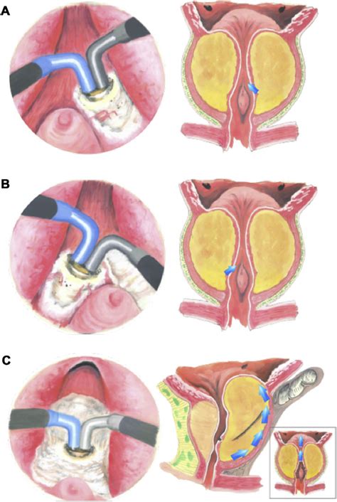 Transurethral Resection Of The Prostate