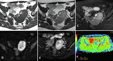 Combination Of Clinical And Mri Features In Diagnosing Ovarian