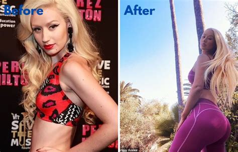 Iggy Azalea Before And After Plastic Surgery Transformation And What Kind Of Surgery She Got Dr