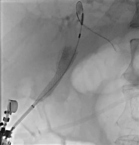 A Fully Covered Self Expandable Metal Stent FCSEMS Was Deployed Near