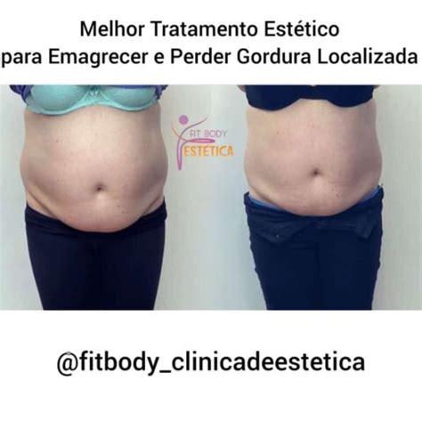 Melhor Tratamento Estético para Emagrecer Clínica Fit Body Estética