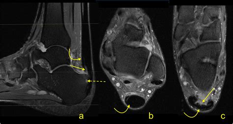 Mri Of The Achilles Tendon A Comprehensive Pictorial Review Part Two European Journal Of