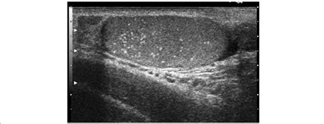 Classic Testicular Microlithiasis Tml Greater Than Or Equal To 5 Per Download Scientific