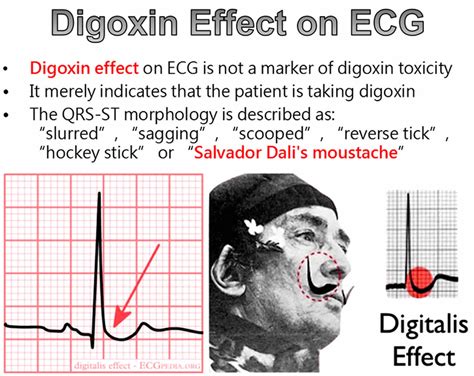 Digoxin Toxicity Signs And Symptoms Causes Ecg Diagnosis And Treatment