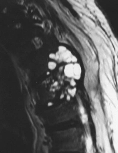 Intervertebral Disk Hydatid Cysts Mr Imaging Findings Ajr