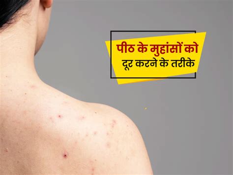 Back Acne पीठ के मुहांसे दूर करने के लिए अपनाएं ये 6 आयुर्वेदिक उपाय