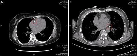 Frontiers Arterial Calcification And Its Association With Stroke