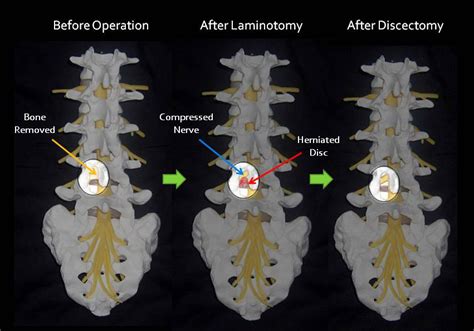 Lmd Lumbar Microdiscectomy Texas Minimally Invasive Spine Surgery