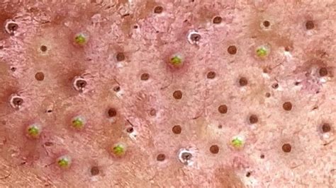 Blackheads Milia Big Cystic Acne Blackheads Extraction Whiteheads